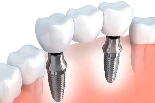 Guided Implant Placement